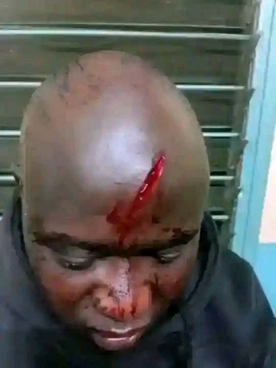 Graphic Image of Anthony Wasama's injury